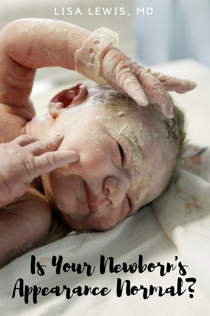 Is Your Newborn's Appearance Normal?